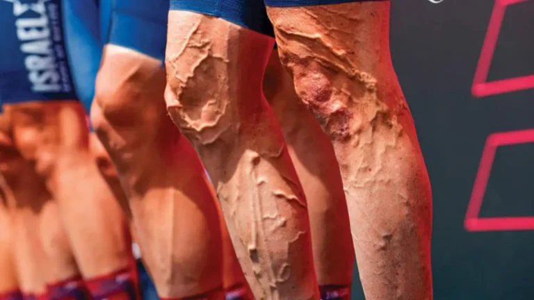 Varicose Veins What You Need to Know