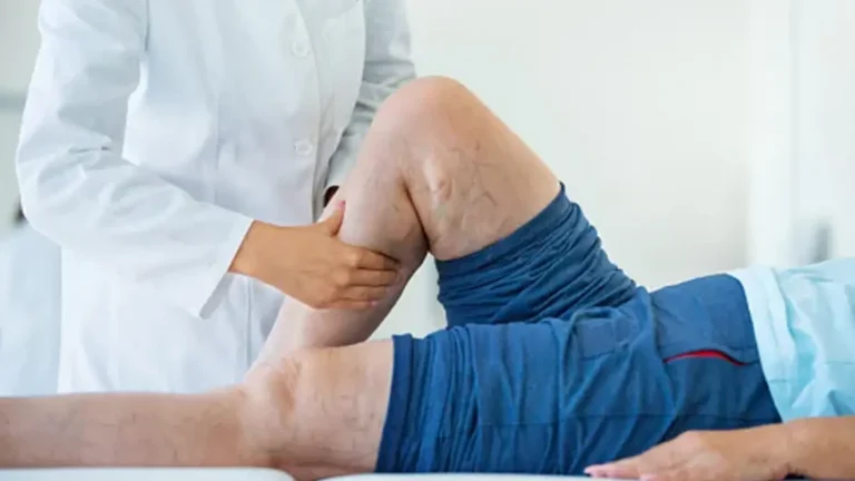 Why to See a Varicose Veins Specialist