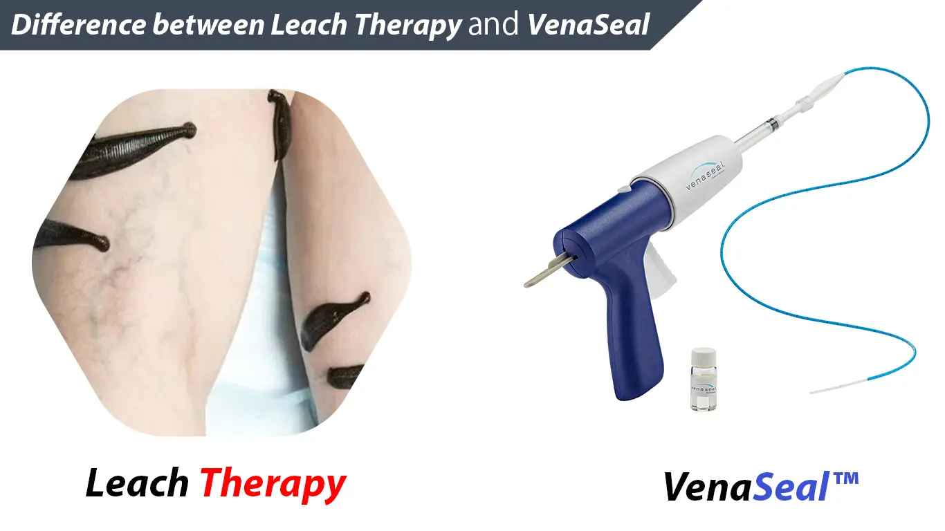 leach therapy vs venaseal