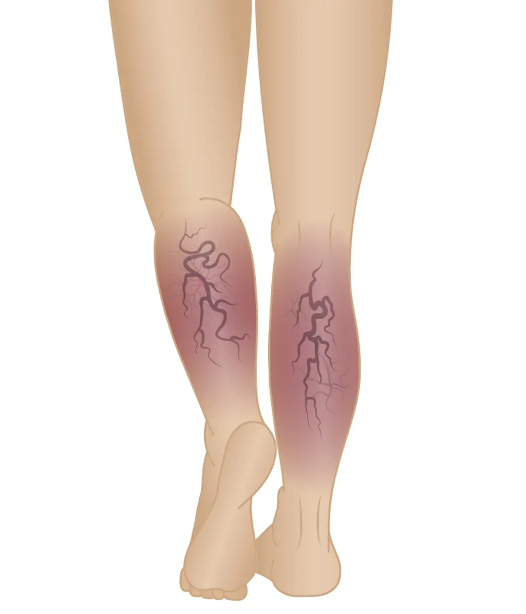Stages-of-Varicose-Veins-Phase-5-Chronic-Venous-Insufficiency