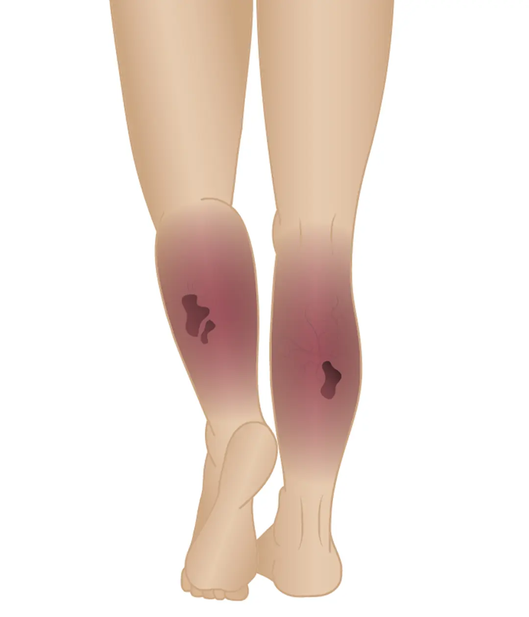 Stages-of-Varicose-Veins-Phase-6-Venous-Ulcer
