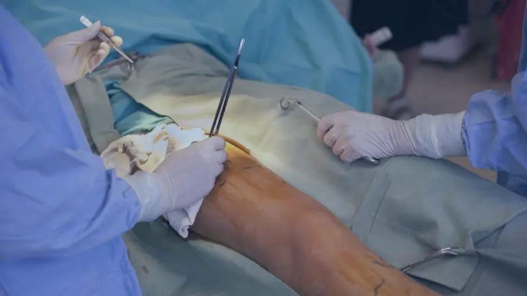 Vein-Stripping-The-Vein-Center