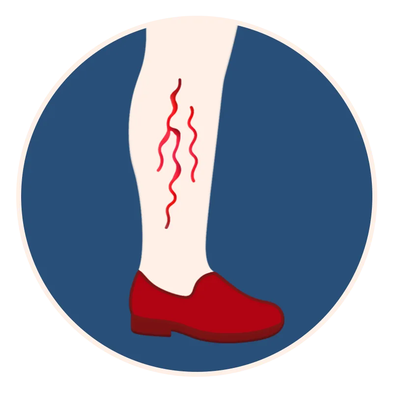 varicose-veins-blue-round