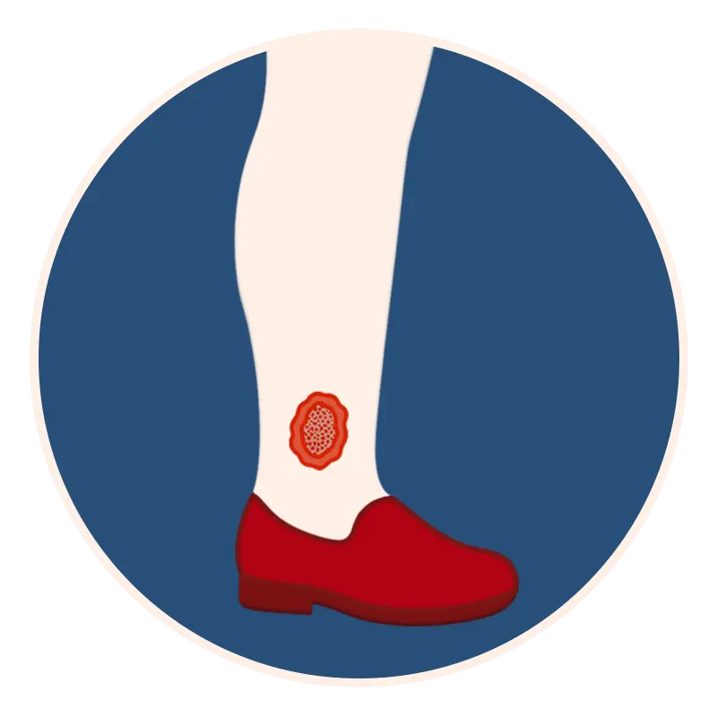 venous-ulcer-treatment-main