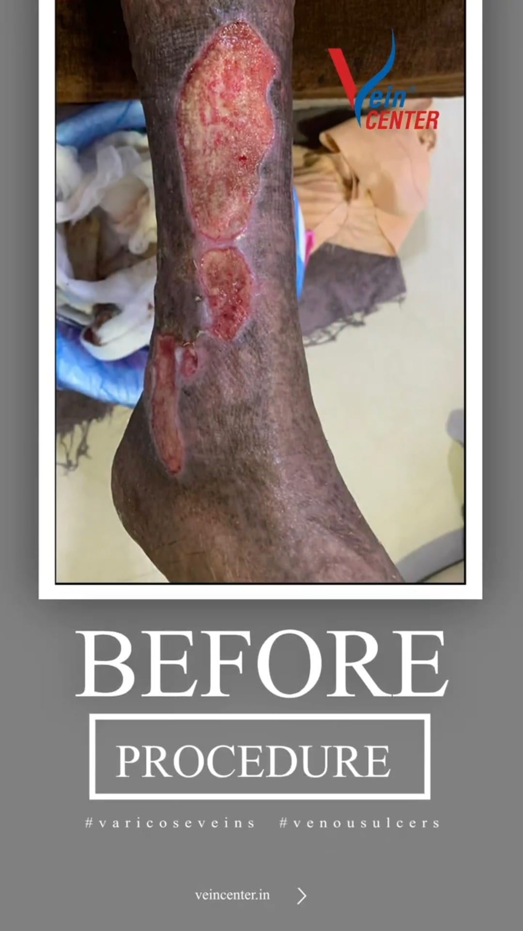 Venous Ulcer Treatment in Mumbai. Before After Results web 1