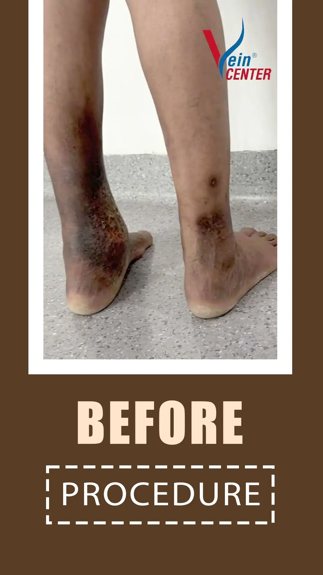 Venous Ulcer Treatment in Mumbai. Before After Results web five