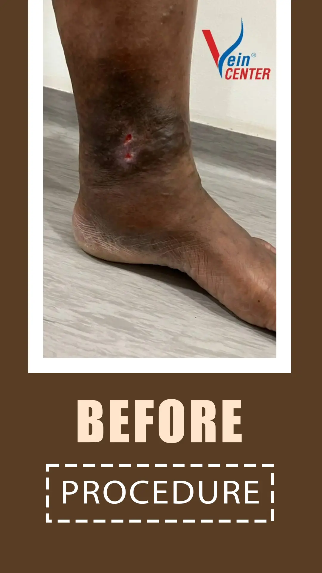Venous Ulcer Treatment in Mumbai. Before After Results web four