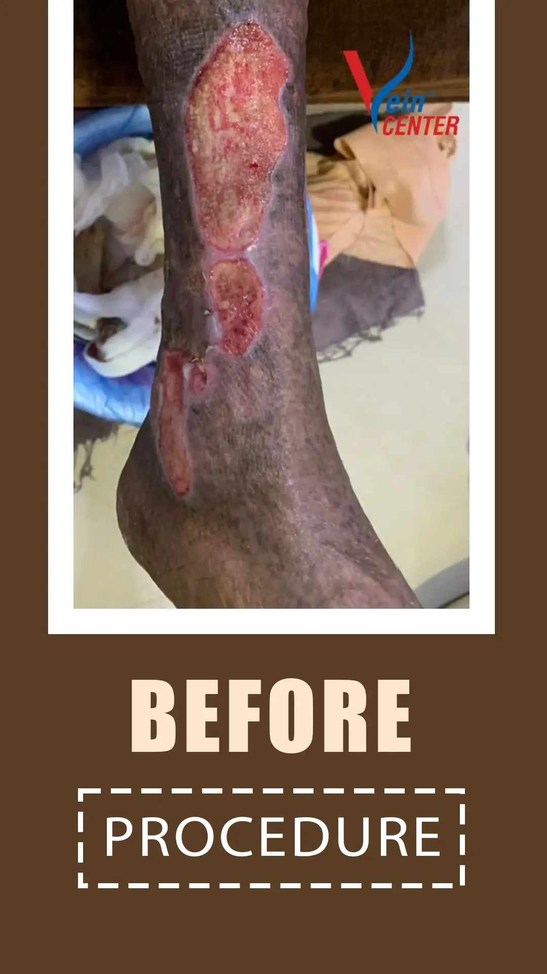 Venous Ulcer Treatment in Mumbai. Before After Results web one