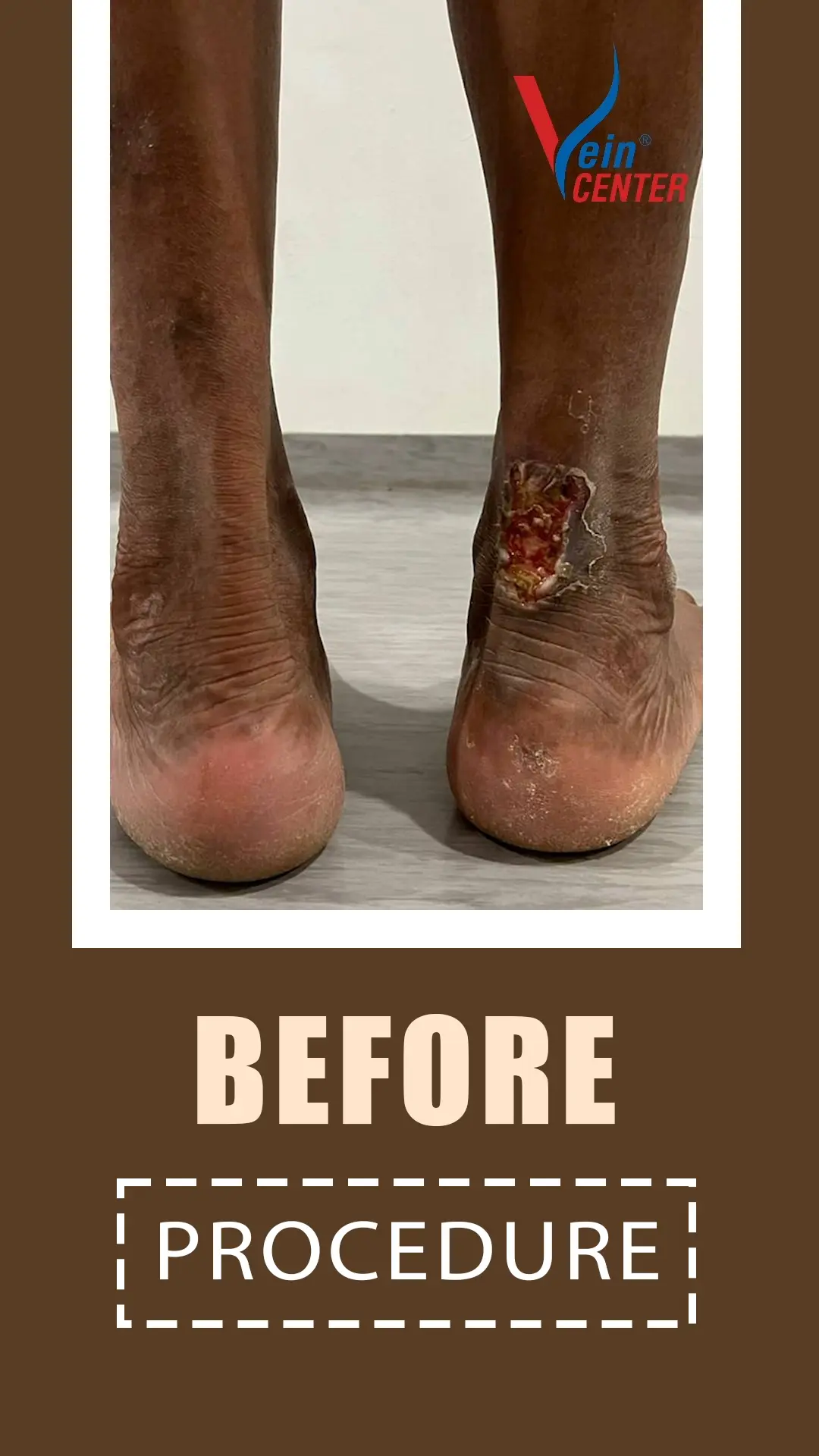 Venous Ulcer Treatment in Mumbai. Before After Results web six