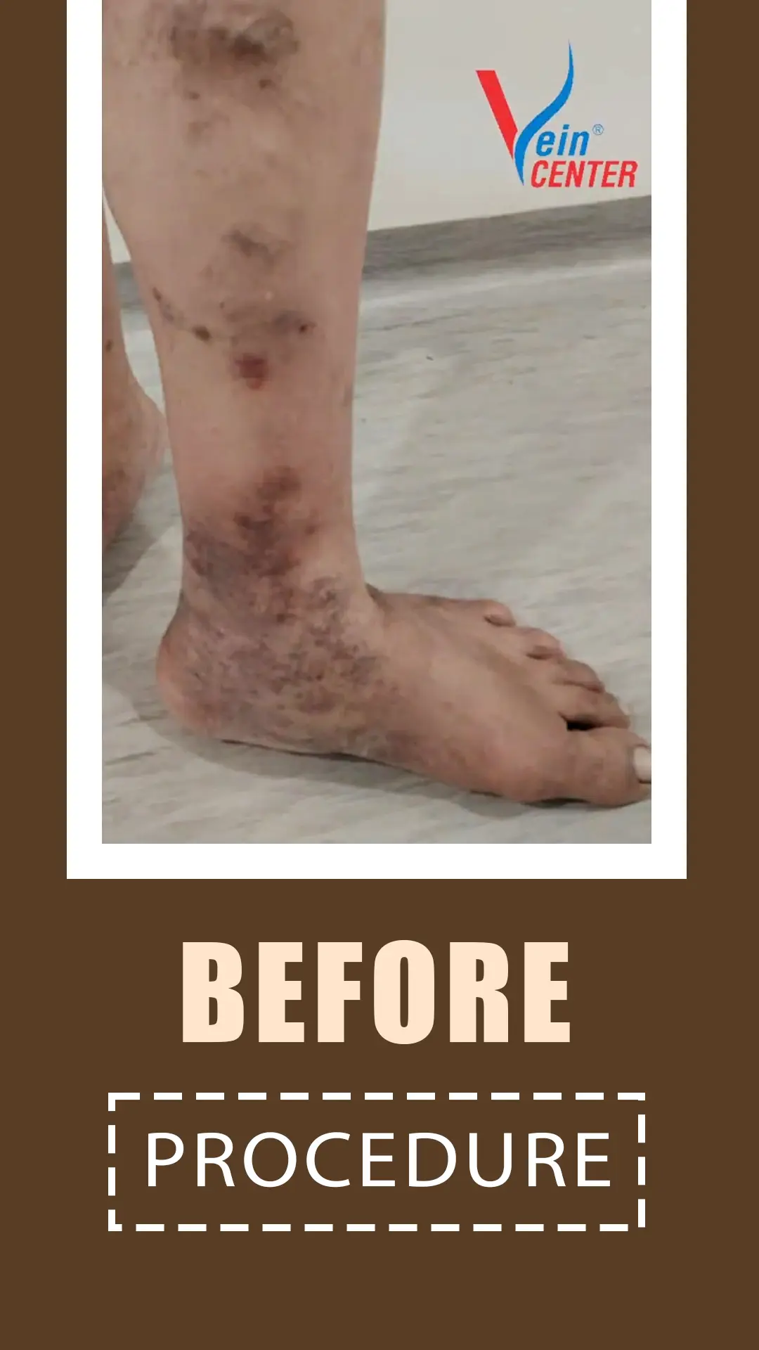Venous Ulcer Treatment in Mumbai. Before After Results web three
